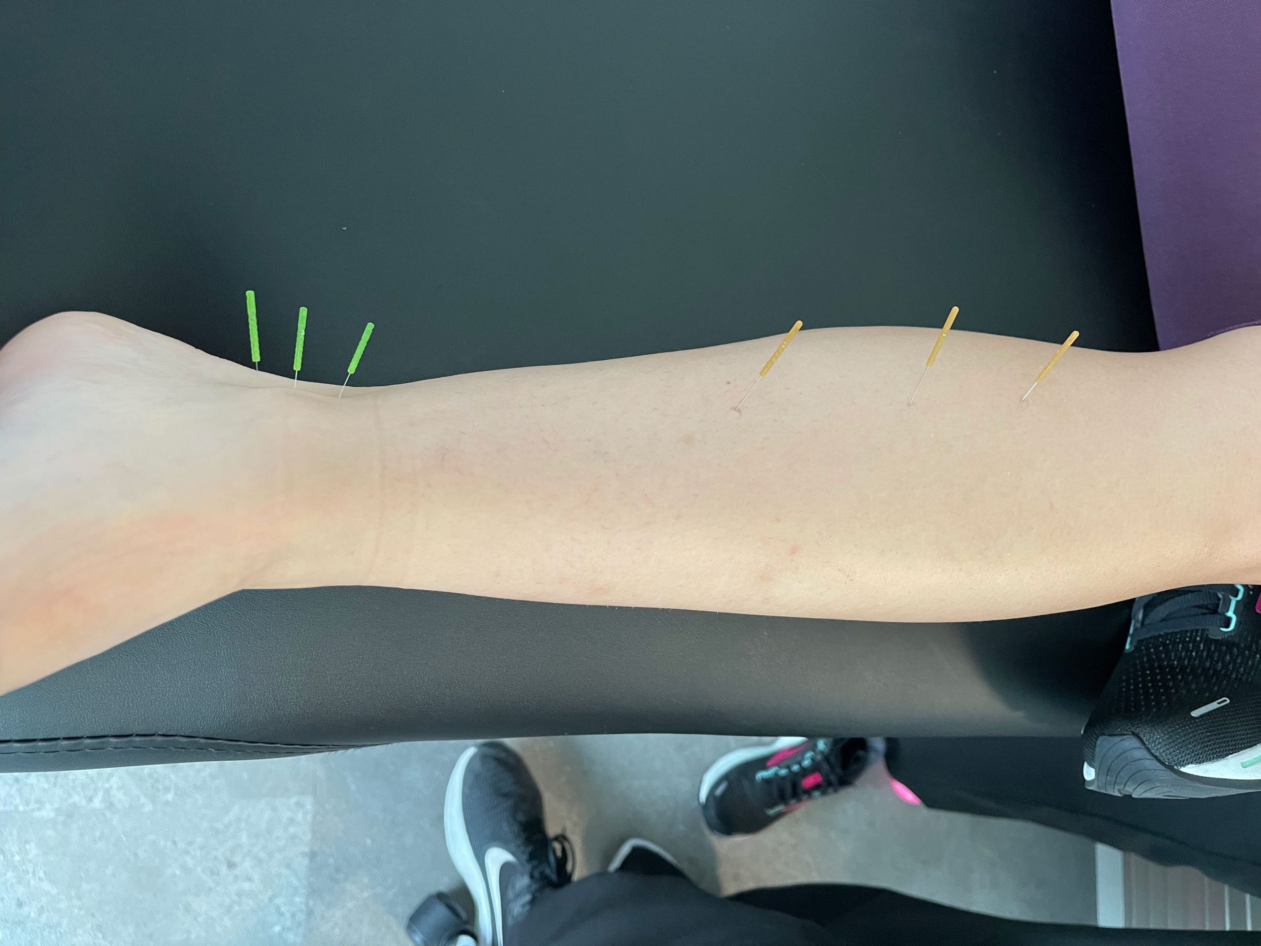 Dry needling